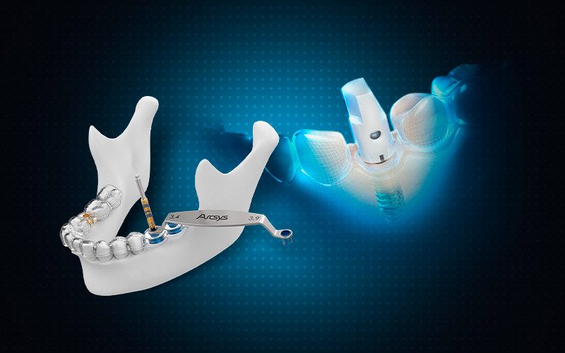 Cirurgia guiada Arcsys — guia cirúrgico sobre a mandíbula e implante posicionado virtualmente