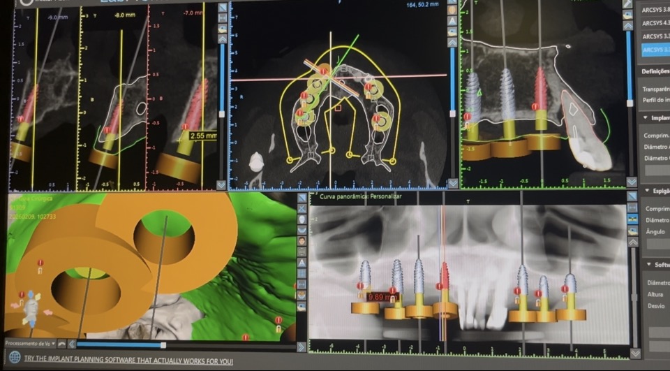 Planejamento digital 3D de implantes com cirurgia guiada